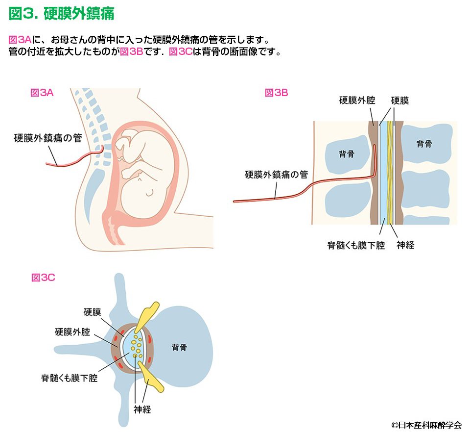 硬膜外鎮痛(出典日本産科麻酔学会)