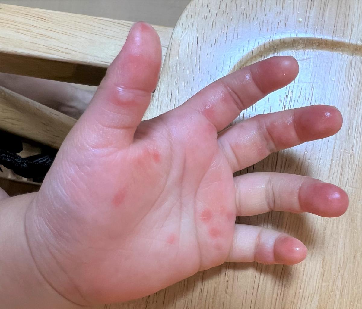 Hand_Foot_and_Mouth_Disease_1