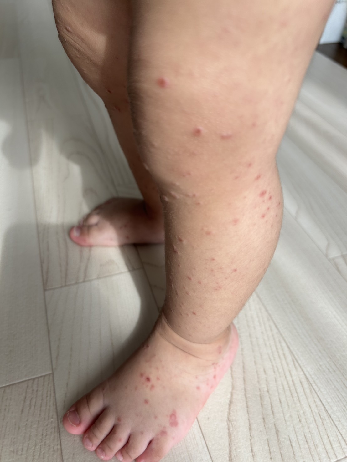 Hand_Foot_and_Mouth_Disease_3