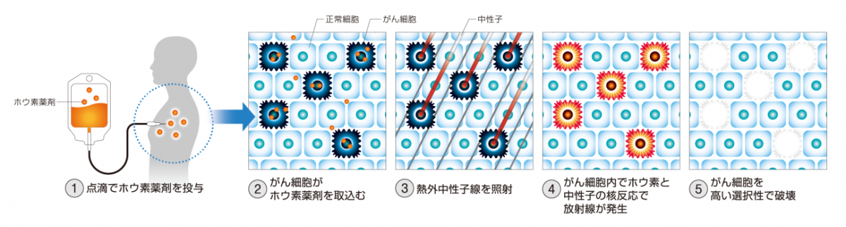 BNCT治療の流れ